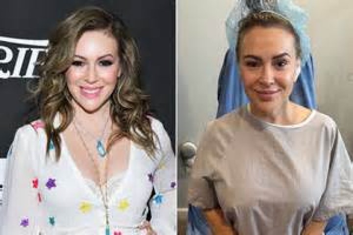 Alyssa Milano Breast Augmentation Plastic Surgery Before and After