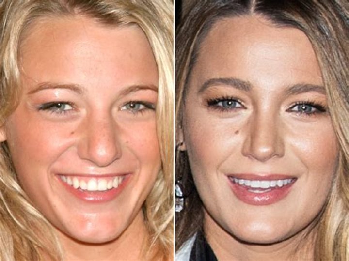 Blake Lively Breast Implants & Nose Job Plastic Surgery – Before and After