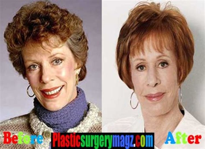 Carol Burnett Plastic Surgery: In Carol's Words About Her Chin Transformation!