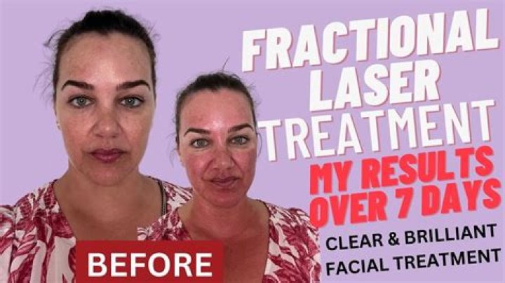 Chelsea Handler Plastic Surgery: Chelsea's Pro Fractional Laser Treatment to Overcome Skin Deficiencies!